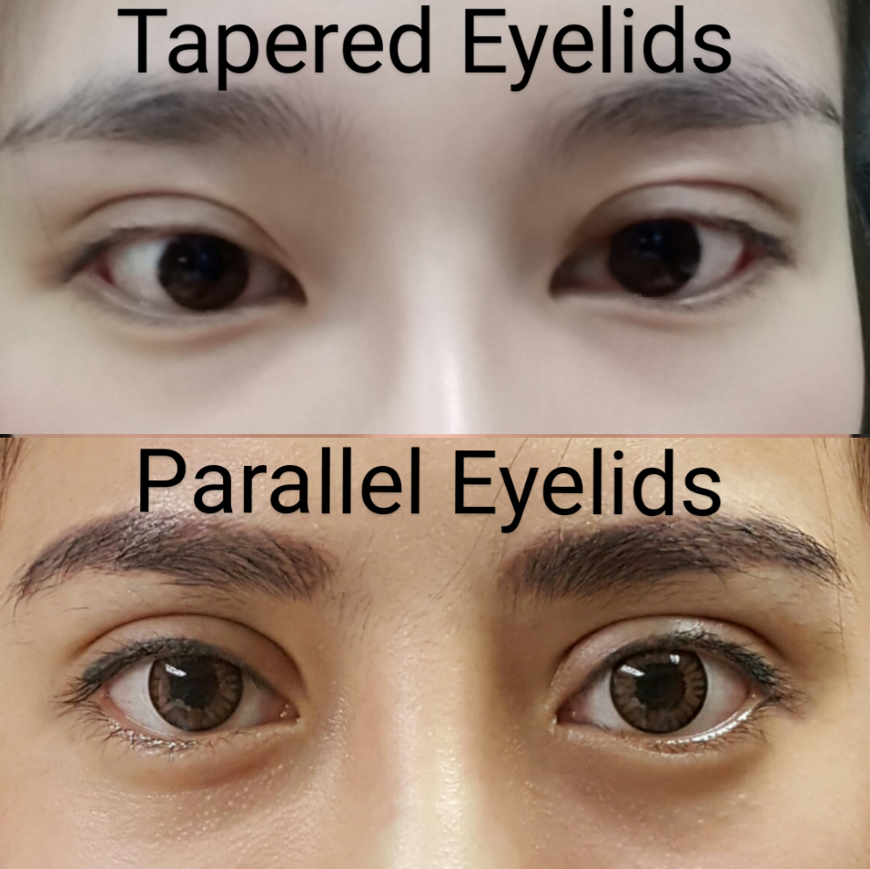 parallel double eyelid surgery