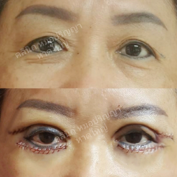 l Lasersurgery Hatyai Skin laser and beauty Lasersurgery Hatyai